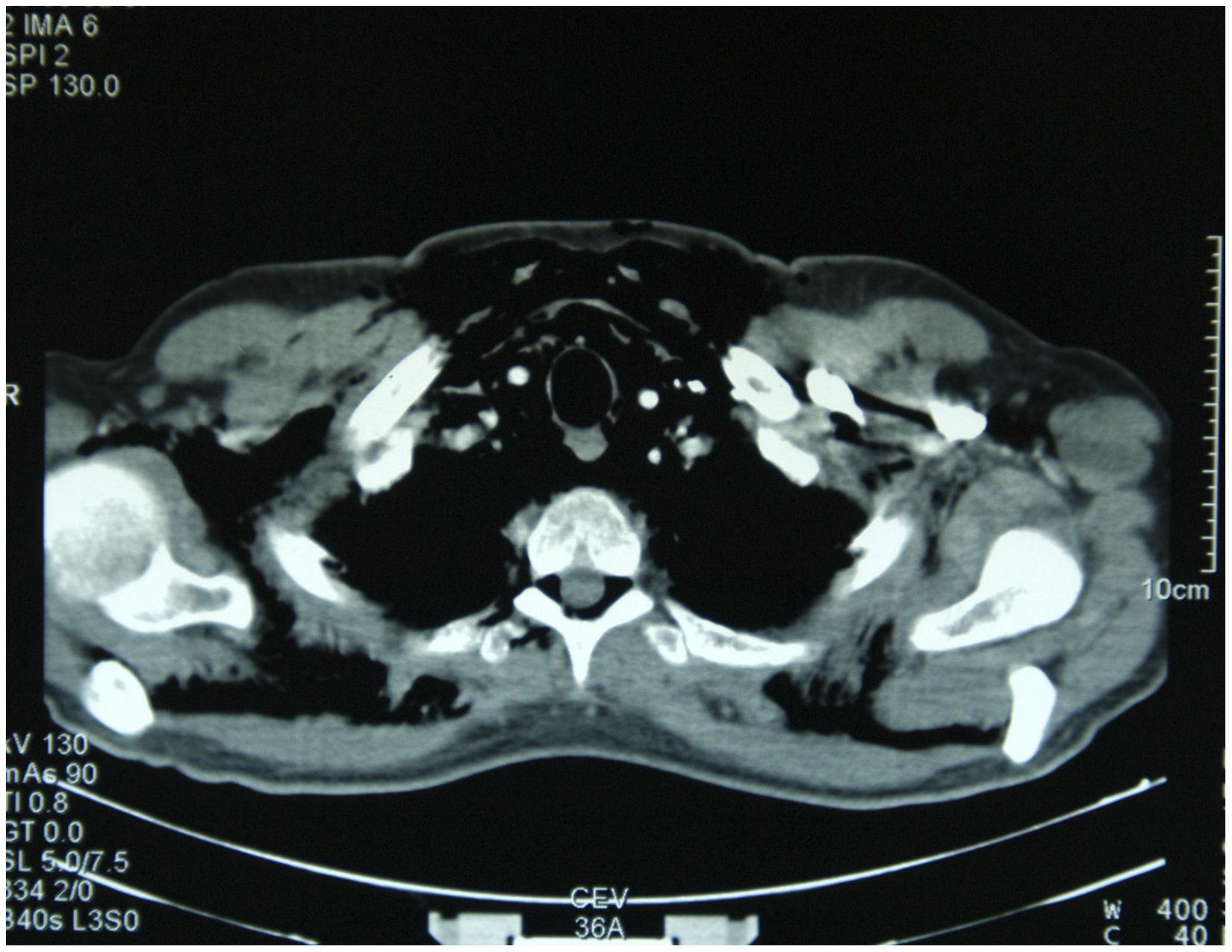 Neumomediastino y daño alveolar difuso. Afección pulmonar severa por ...